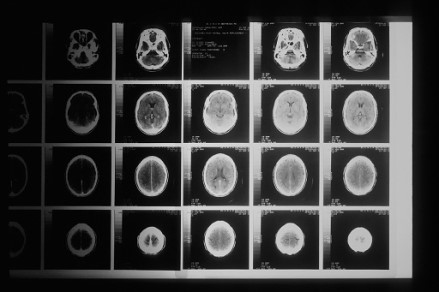 Aggressive Brain Tumours: Promise in ALS Drug for Treatment